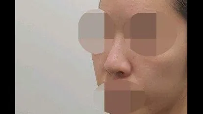 Lower Eyelid Fat Grafting, Nasal Tip 2