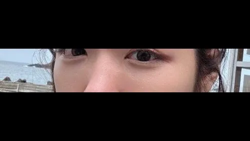 Lower Eyelid Fat Grafting, Nasal Tip — RE&RE PLASTIC SURGERY 3