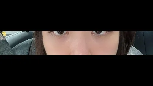 Lower Eyelid Fat Grafting, Nasal Tip — RE&RE PLASTIC SURGERY 4