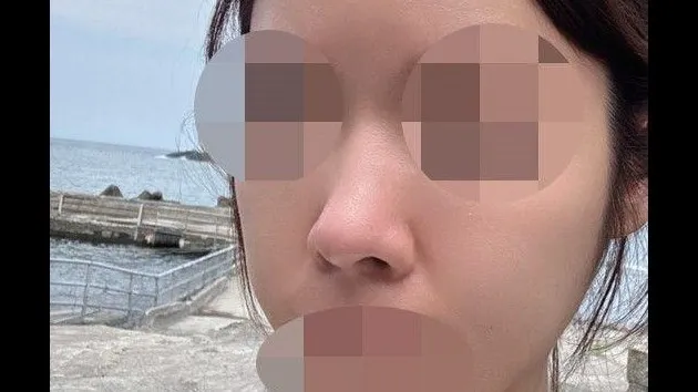 Lower Eyelid Fat Grafting, Nasal Tip — RE&RE PLASTIC SURGERY 5
