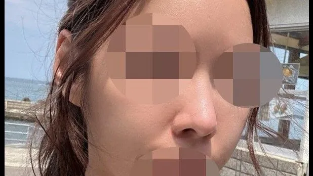 Lower Eyelid Fat Grafting, Nasal Tip — RE&RE PLASTIC SURGERY 6