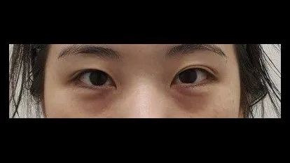 部分切開二重術, 目つき矯正, 目つき矯正再手術 1