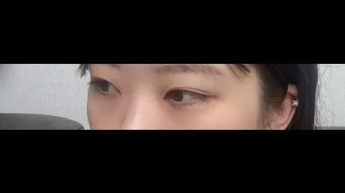 部分切開二重術, 目つき矯正, 目つき矯正再手術 — RE&RE PLASTIC SURGERY 3