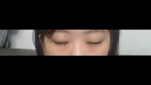 部分切開二重術, 目つき矯正, 目つき矯正再手術 — RE&RE PLASTIC SURGERY 4