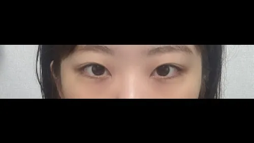 部分切開二重術, 目つき矯正, 目つき矯正再手術 — RE&RE PLASTIC SURGERY 5