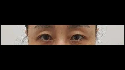 Sub-brow Lift, Full-Face Thread lift 1