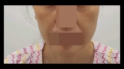 Sub-brow Lift, Full-Face Thread lift 2