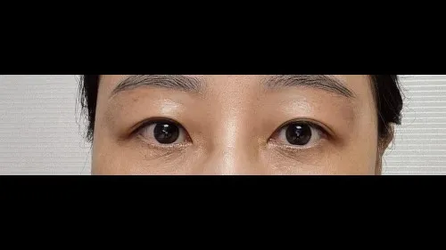 Sub-brow Lift, Full-Face Thread lift — RE&RE PLASTIC SURGERY 3