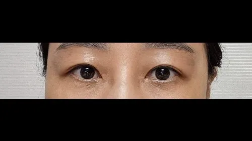 Sub-brow Lift, Full-Face Thread lift — RE&RE PLASTIC SURGERY 4