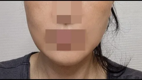 Sub-brow Lift, Full-Face Thread lift — RE&RE PLASTIC SURGERY 5