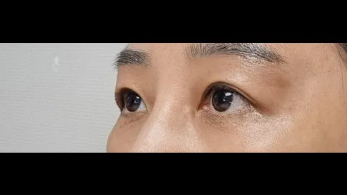 Sub-brow Lift, Full-Face Thread lift — RE&RE PLASTIC SURGERY 6