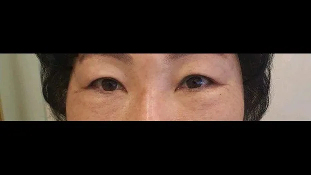 Sub-brow Lift — RE&RE PLASTIC SURGERY 2