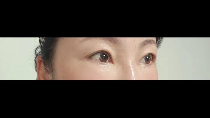 Sub-brow Lift — RE&RE PLASTIC SURGERY 3