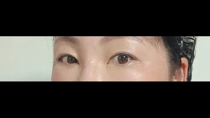 Sub-brow Lift — RE&RE PLASTIC SURGERY 4