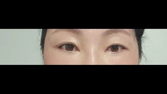Sub-brow Lift — RE&RE PLASTIC SURGERY 5