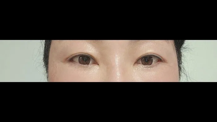 Sub-brow Lift — RE&RE PLASTIC SURGERY 6