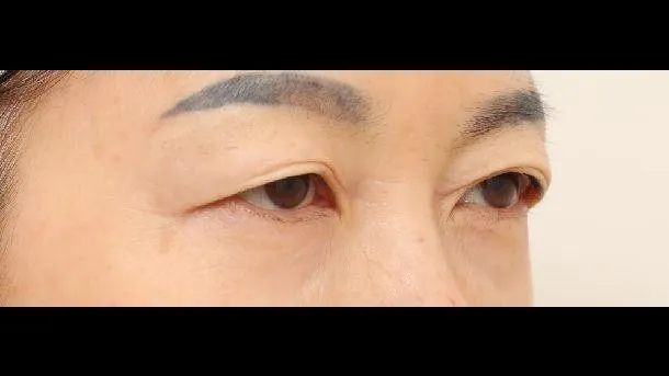 Sub-brow Lift, Ptosis Correction — RE&RE PLASTIC SURGERY 2