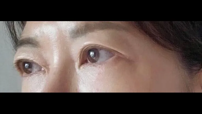 Sub-brow Lift, Ptosis Correction — RE&RE PLASTIC SURGERY 3
