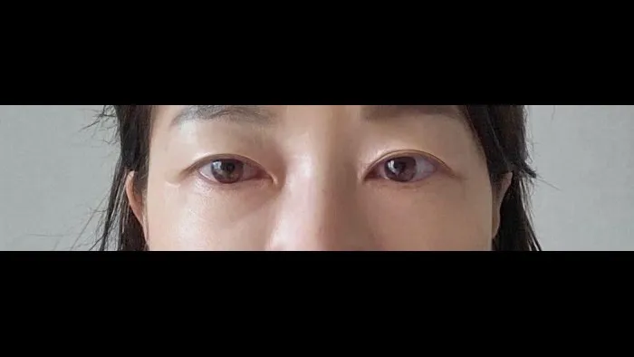 Sub-brow Lift, Ptosis Correction — RE&RE PLASTIC SURGERY 4