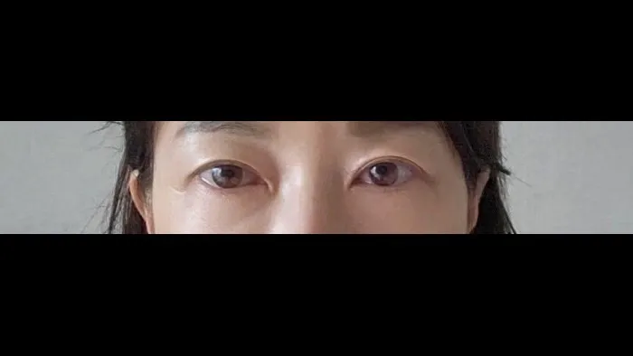 Sub-brow Lift, Ptosis Correction — RE&RE PLASTIC SURGERY 5