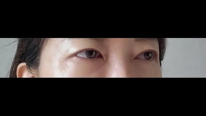 Sub-brow Lift, Ptosis Correction — RE&RE PLASTIC SURGERY 6
