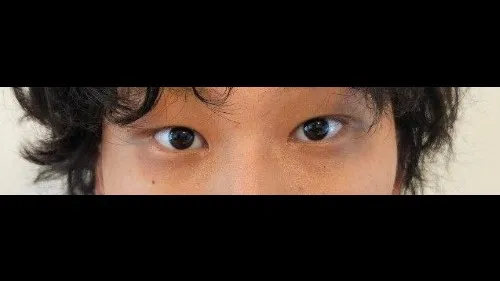 Partial Incision Double Eyelid Surgery, Ptosis Correction — RE&RE PLASTIC SURGERY 2