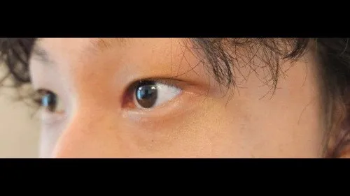 Partial Incision Double Eyelid Surgery, Ptosis Correction — RE&RE PLASTIC SURGERY 3