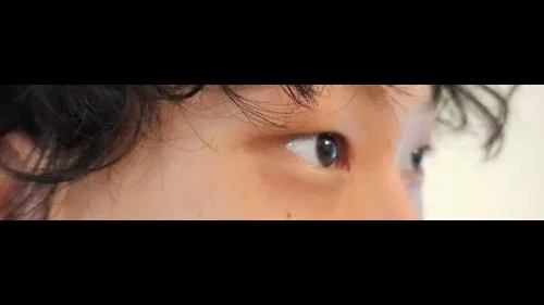 Partial Incision Double Eyelid Surgery, Ptosis Correction — RE&RE PLASTIC SURGERY 4