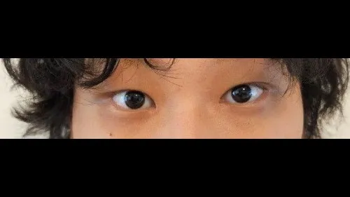 Partial Incision Double Eyelid Surgery, Ptosis Correction — RE&RE PLASTIC SURGERY 5