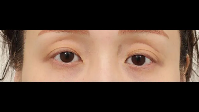 Natural Adhesion Double Eyelid Surgery, Facial Fat Grafting, Lower Eyelid Fat Grafting 1