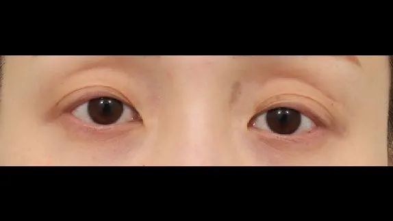 Natural Adhesion Double Eyelid Surgery, Facial Fat Grafting, Lower Eyelid Fat Grafting — RE&RE PLASTIC SURGERY 2