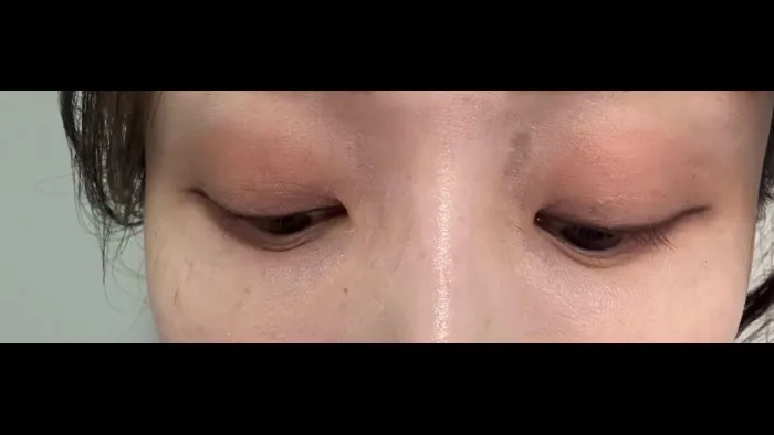 Natural Adhesion Double Eyelid Surgery, Facial Fat Grafting, Lower Eyelid Fat Grafting — RE&RE PLASTIC SURGERY 3