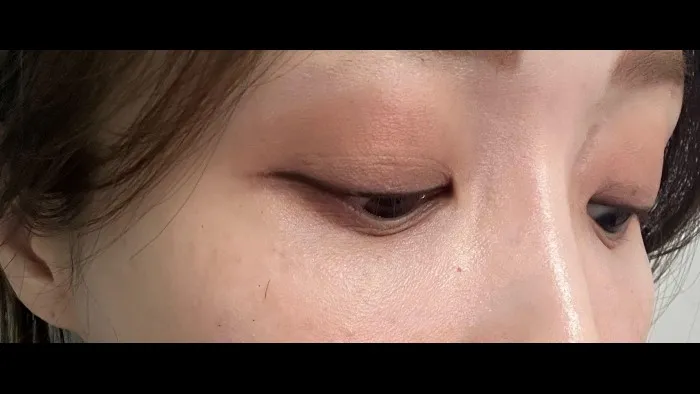 Natural Adhesion Double Eyelid Surgery, Facial Fat Grafting, Lower Eyelid Fat Grafting — RE&RE PLASTIC SURGERY 4