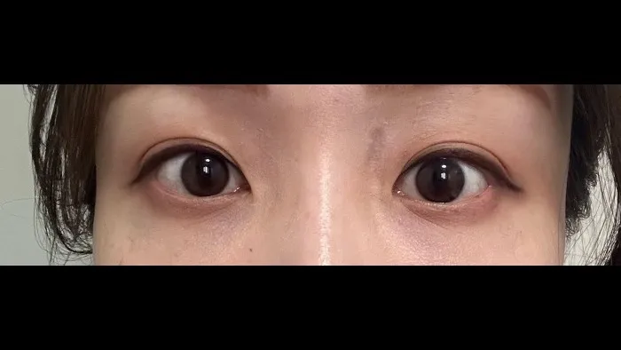 Natural Adhesion Double Eyelid Surgery, Facial Fat Grafting, Lower Eyelid Fat Grafting — RE&RE PLASTIC SURGERY 5