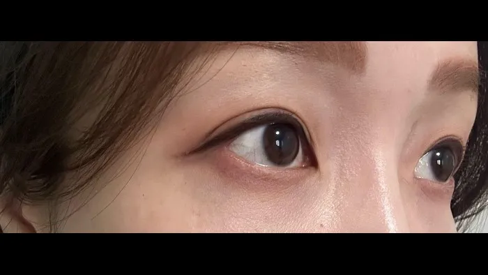 Natural Adhesion Double Eyelid Surgery, Facial Fat Grafting, Lower Eyelid Fat Grafting — RE&RE PLASTIC SURGERY 6
