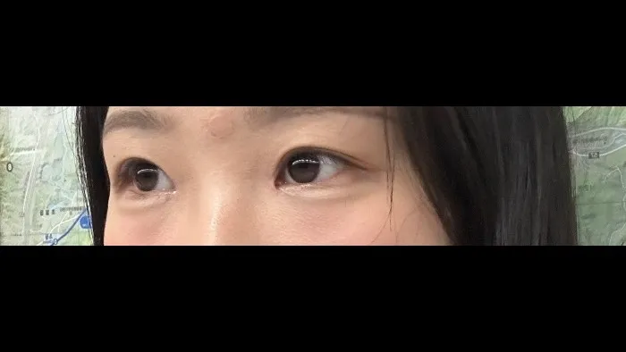 Natural Adhesion Double Eyelid Surgery, Ptosis Correction — RE&RE PLASTIC SURGERY 2
