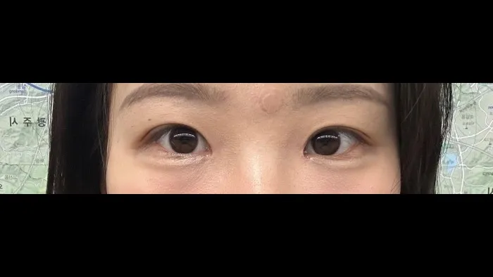 Natural Adhesion Double Eyelid Surgery, Ptosis Correction — RE&RE PLASTIC SURGERY 3