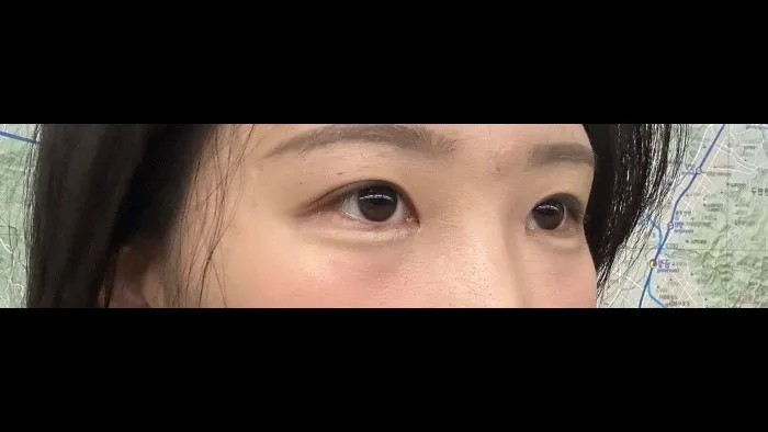 Natural Adhesion Double Eyelid Surgery, Ptosis Correction — RE&RE PLASTIC SURGERY 4