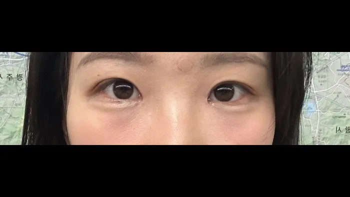 Natural Adhesion Double Eyelid Surgery, Ptosis Correction — RE&RE PLASTIC SURGERY 5