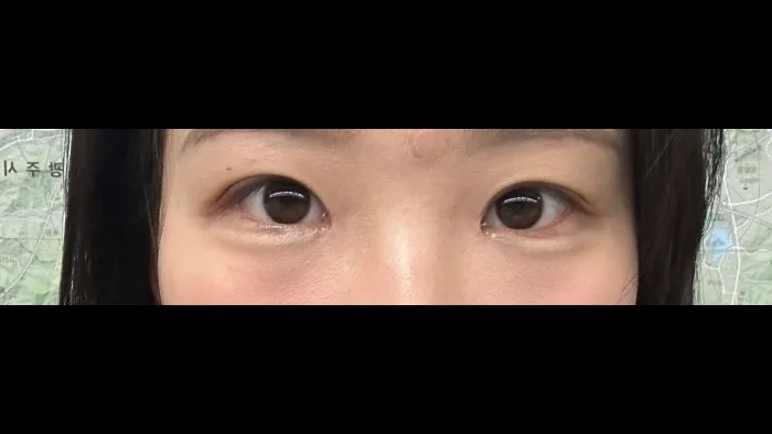 Natural Adhesion Double Eyelid Surgery, Ptosis Correction — RE&RE PLASTIC SURGERY 6
