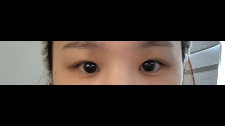 Ptosis Correction, Incisional Double Eyelid Surgery — RE&RE PLASTIC SURGERY 2