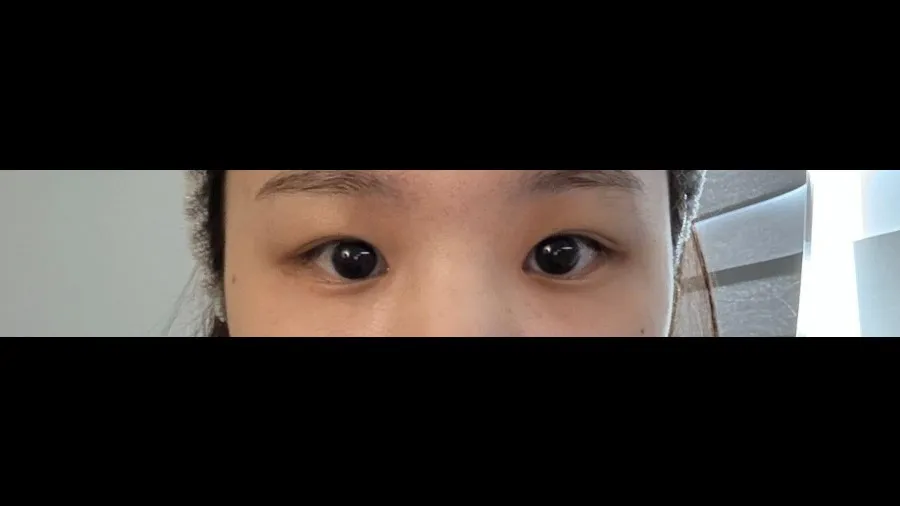 Ptosis Correction, Incisional Double Eyelid Surgery — RE&RE PLASTIC SURGERY 3