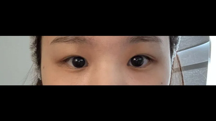 Ptosis Correction, Incisional Double Eyelid Surgery — RE&RE PLASTIC SURGERY 4