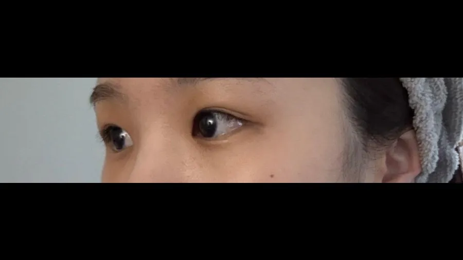 Ptosis Correction, Incisional Double Eyelid Surgery — RE&RE PLASTIC SURGERY 5