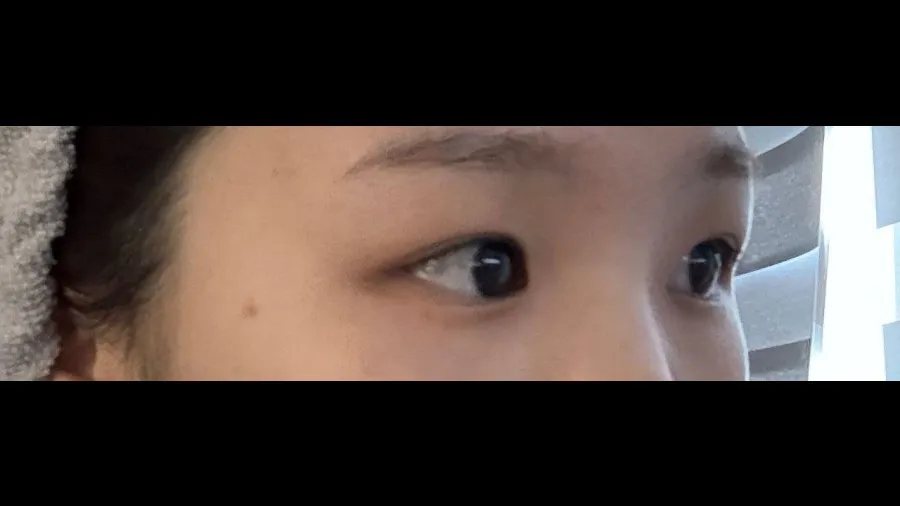 Ptosis Correction, Incisional Double Eyelid Surgery — RE&RE PLASTIC SURGERY 6
