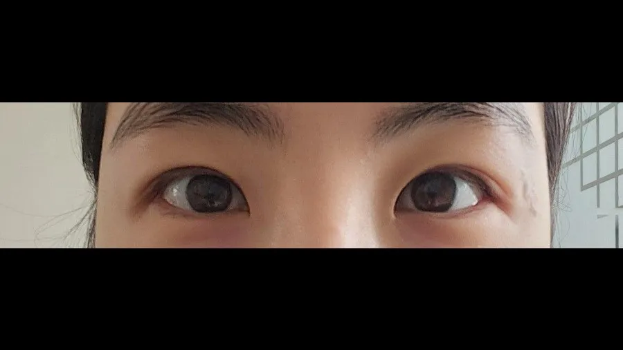 Incisional Double Eyelid Surgery — RE&RE PLASTIC SURGERY 2