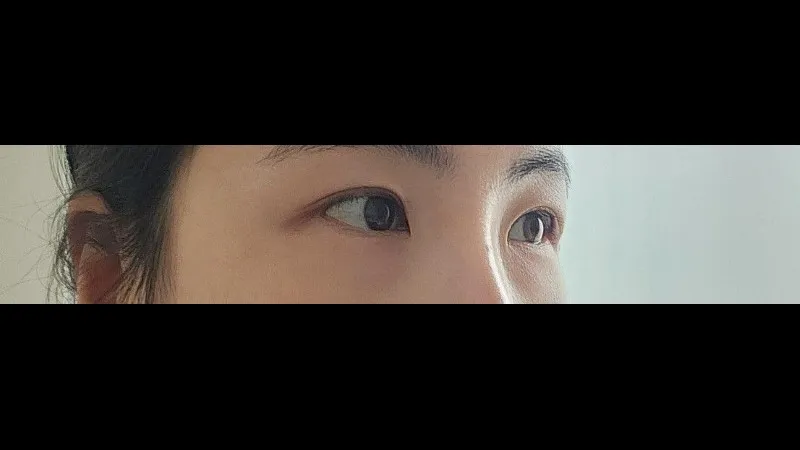 Incisional Double Eyelid Surgery — RE&RE PLASTIC SURGERY 4