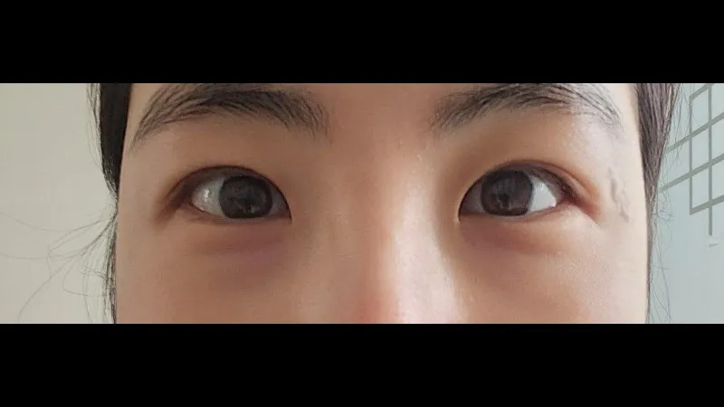 Incisional Double Eyelid Surgery — RE&RE PLASTIC SURGERY 5