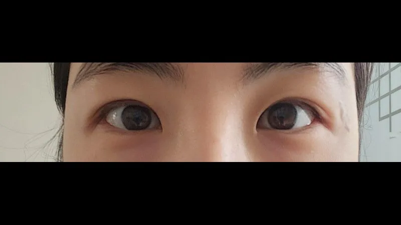 Incisional Double Eyelid Surgery — RE&RE PLASTIC SURGERY 6