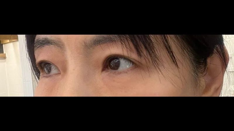 Sub-brow Lift, Natural Adhesion Double Eyelid Surgery — RE&RE PLASTIC SURGERY 2